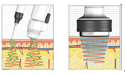 Electroporation Skin Treatment: Revitalize Your Complexion Safely