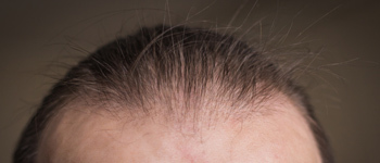 Changes-in-Hairline