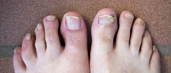 Distal-Subfungal-Infections
