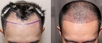 How-Do-Hair-Transplant-Work-In-Men