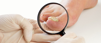 What-Is-Fungal-Infection-of-the-Nail