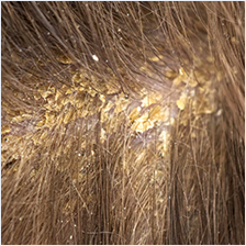 Itchy Scalp Treatment for Seborrheic Dermatitis