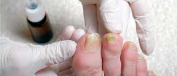 How-Does-a-Fungal-Nail-Infection-Happen