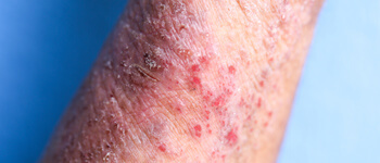 The-Dangers-Of-Dry-Skin-For-Dermatitis