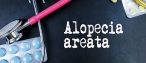 Topical-Treatment-for-Alopecia-Areata
