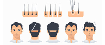 Follicular-Unit-Transplantation-(FUT)