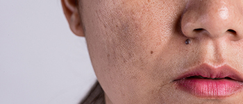 Post-inflammatory Hyperpigmentation/Hypopigmentation