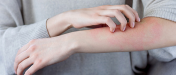 Contact Dermatitis