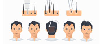 Follicular-Unit-Extraction-(FUE)