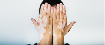 Vitiligo: Myths Vs Facts