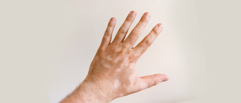 Symptoms of Vitiligo