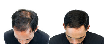 Hair-Transplant-Side-Effects