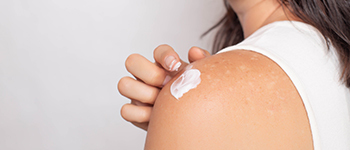 Skin Care Tips for Vitiligo Patients