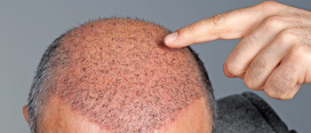 Hair-Transplant-Side-Effects