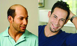 treatment options for baldness