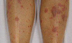 Lichen Planus: Causes