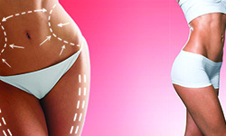 Tumescent liposuction