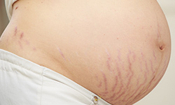 Who is eligible for laser stretch mark removal?