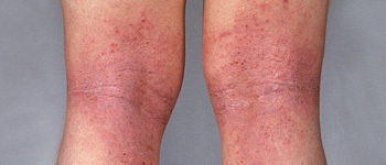 Atopic Dermatitis or Atopic Eczema