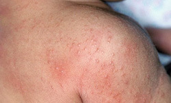 What Causes Hives?