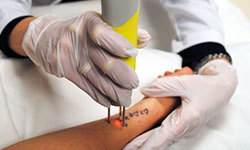 Does laser tattoo removal hurt