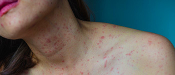 Contact Dermatitis or Contact Eczema