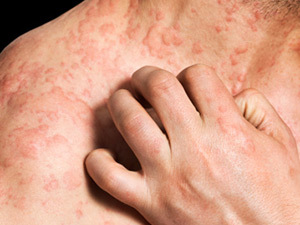 What Are The Signs And Symptoms Of Hives