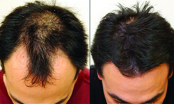 hair loss in men