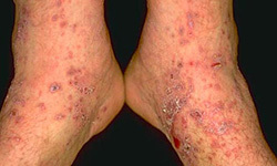 Lichen Planus: Treatment