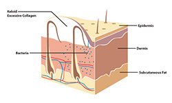 What Causes Keloids?