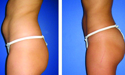 S.A.F.E. Liposuction