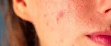 Papules