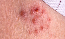 Shin spots or diabetic dermopathy