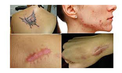 Types Of Keloid Scars