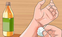 How To Treat Hives 
