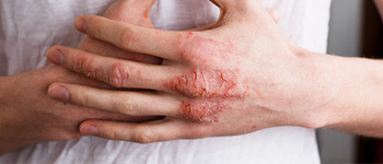 Dyshidrotic Dermatitis