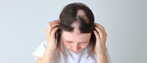 Alopecia Areata - Stress-Related Hair Loss