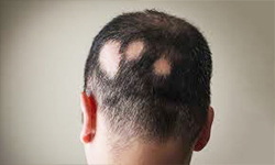 alopecia_areata