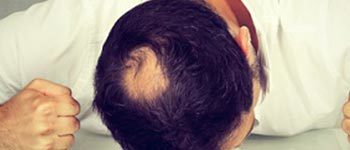 Androgenic-Alopecia