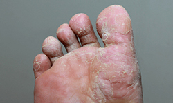 Athlete's Foot (Tinea Pedis)