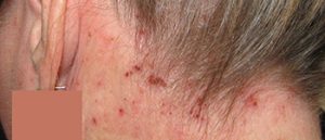 Atopic_Dermatitis