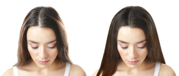 Best Candidates for Hair Transplant for Women