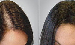 What are the advantages of stem cell hair loss therapy?