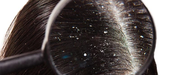 What is dandruff