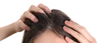 Who’s Prone to Develop Dandruff