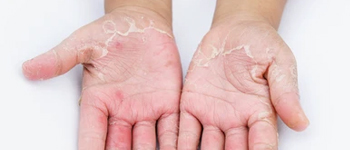 Contact Dermatitis