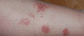 Nummular Dermatitis