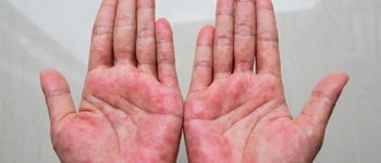 Hand Eczema