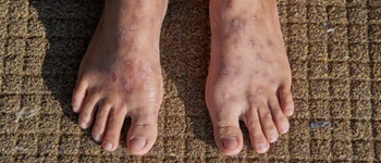 Stasis Dermatitis