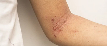 Symptoms of Atopic Eczema